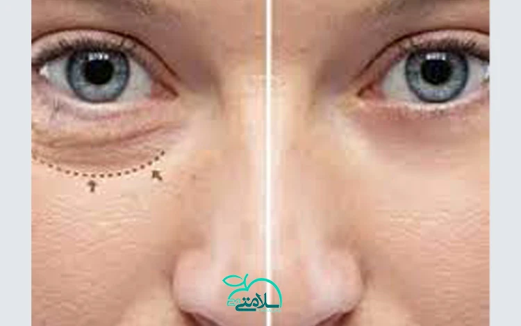 جراحی بلفاروپلاستی: همه آنچه که باید بدانید